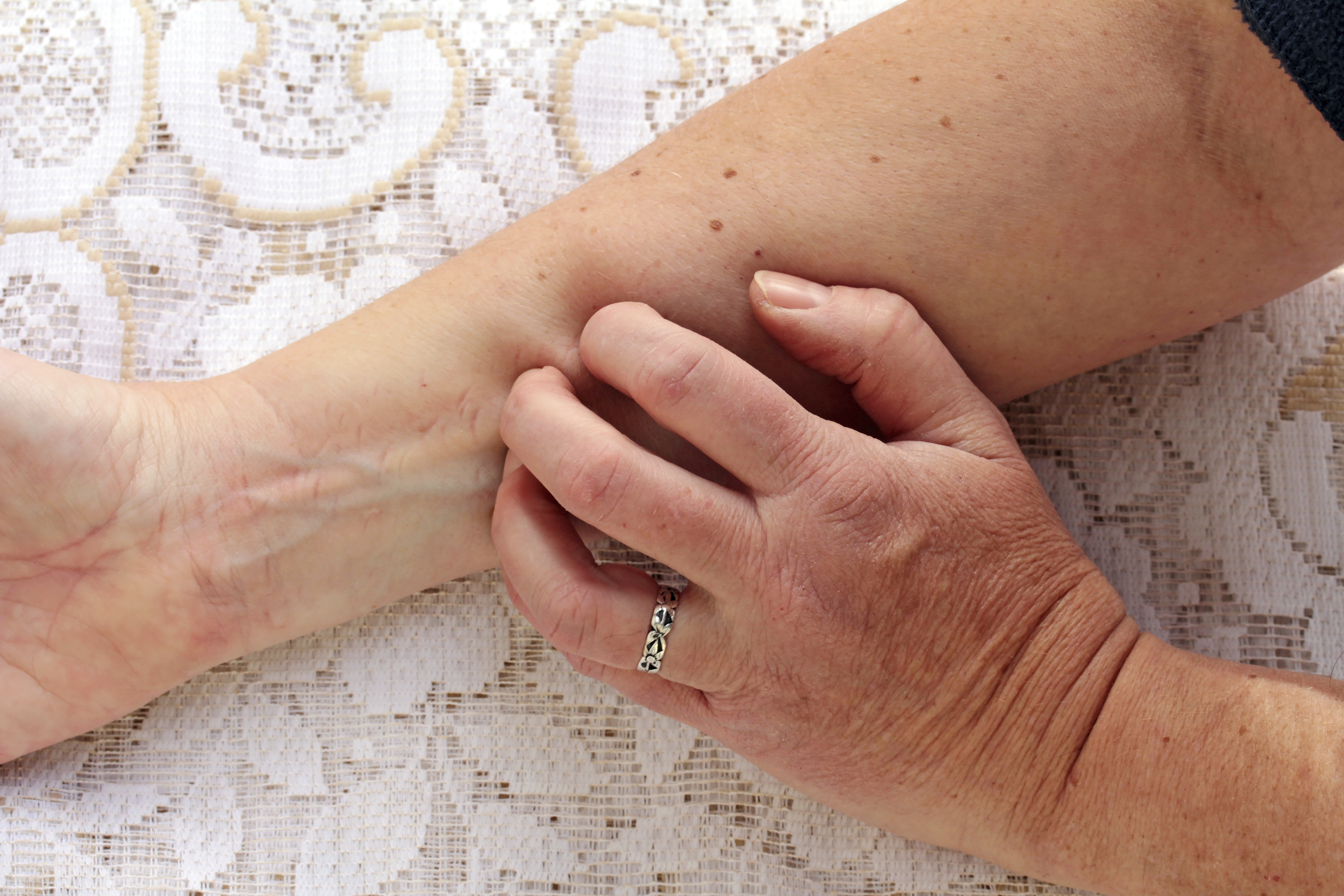 How do you prevent skin rashes?